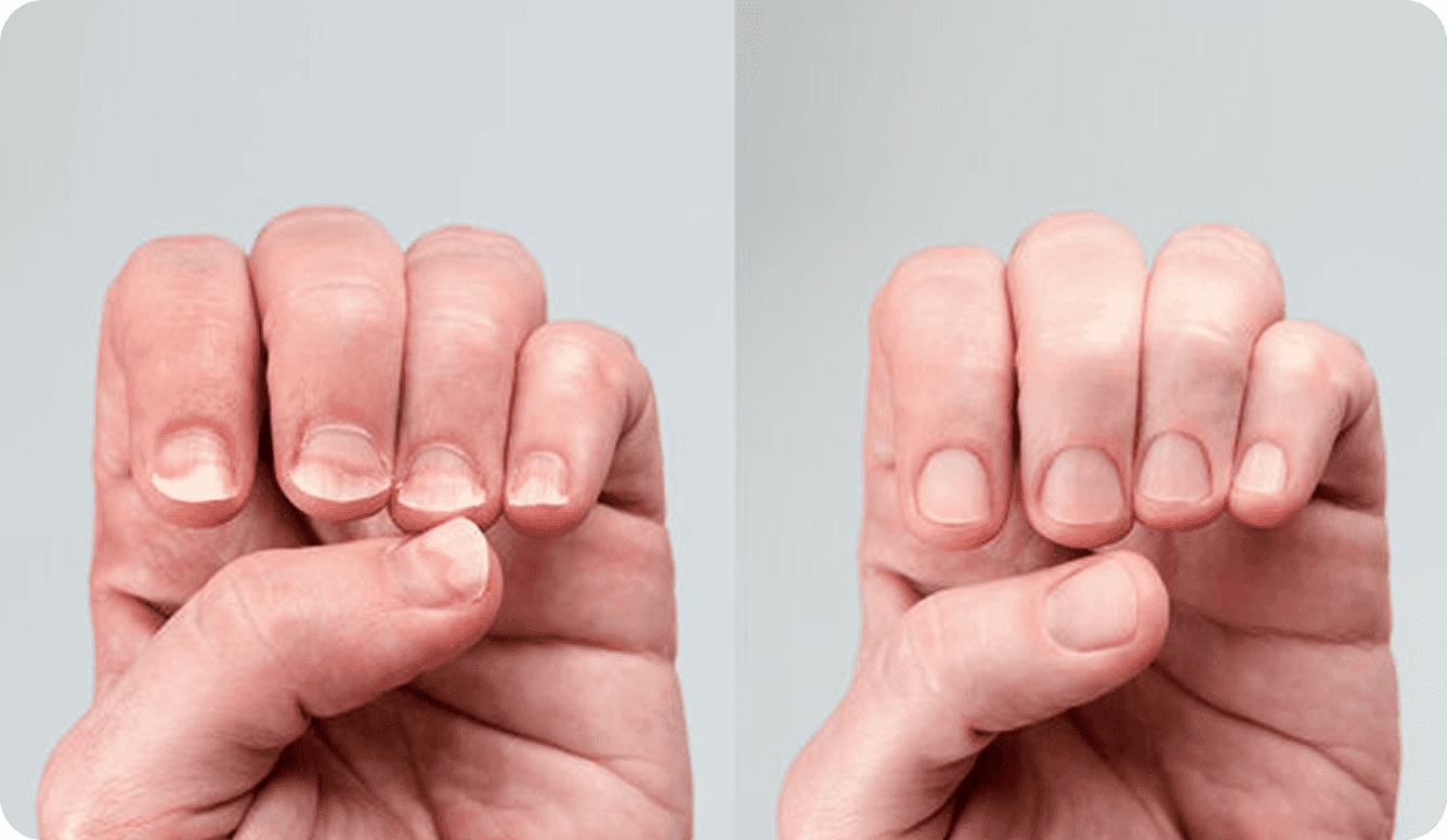 Before-and-after style comparison illustrating nail appearance